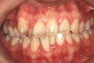 叢生（八重歯）-大人／治療前／正面