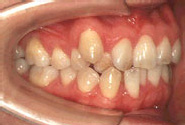叢生（八重歯）-大人／治療前／側面