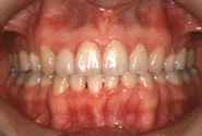 叢生（八重歯）-大人／治療前／正面
