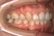 叢生（八重歯）-大人／治療前／側面
