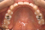 叢生（八重歯）-大人／治療前／内側