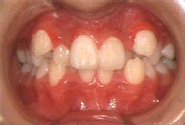 叢生（八重歯）-子供／治療前／正面
