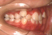 叢生（八重歯）-子供／治療前／側面