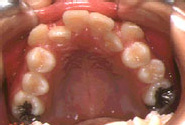 叢生（八重歯）-子供／治療前／内側