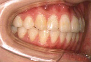 叢生（八重歯）-子供／治療前／側面