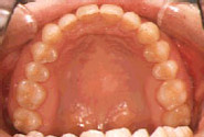 出っ歯-大人／治療前／内側