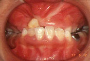 唇顎口蓋裂（保険適用症）／治療前／正面