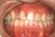 唇顎口蓋裂（保険適用症）／治療前／正面