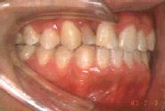 唇顎口蓋裂（保険適用症）／治療前／側面