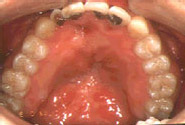 唇顎口蓋裂（保険適用症）／治療前／内側